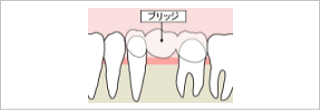 ブリッジ