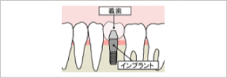 インプラント